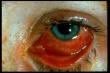 Đau mắt đỏ dùng thuốc gì ?