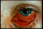 Đau mắt đỏ dùng thuốc gì ?